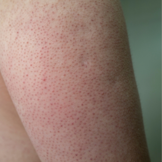 Keratosis Pilaris skin condition on the back of an arm